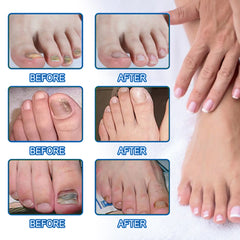 Nail Repair Bandage